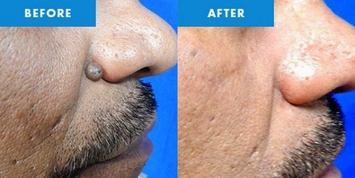 cryotherapy-treatments-hertforshire 2